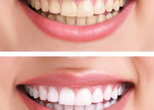 Teeth Whitening